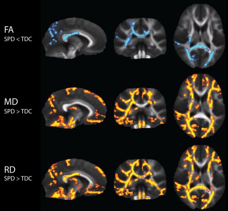 UCSF Study Shows Measurable Neurological Differences In Affected Children